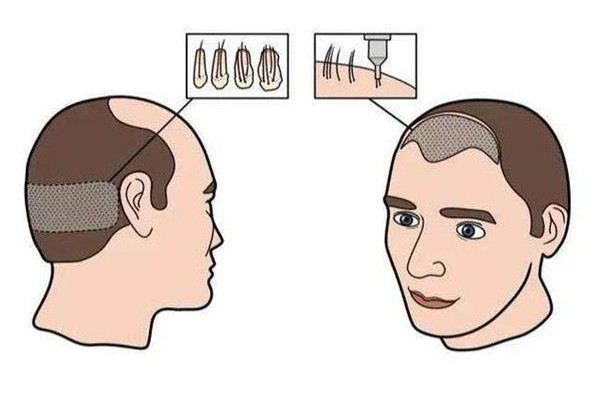 植發(fā)前需要做哪些準備 植發(fā)前驗血是要檢查什么 植發(fā)前需要做哪些準備 植發(fā)前驗血是要檢查什么