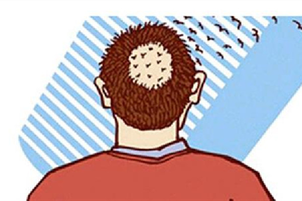 植發(fā)毛囊存活率高嗎 植發(fā)毛囊不夠怎么辦 植發(fā)毛囊存活率高嗎 植發(fā)毛囊不夠怎么辦