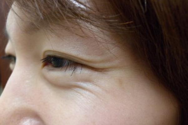 魚(yú)尾紋怎么才能去掉 魚(yú)尾紋是哪個(gè)部位 魚(yú)尾紋怎么才能去掉 魚(yú)尾紋是哪個(gè)部位