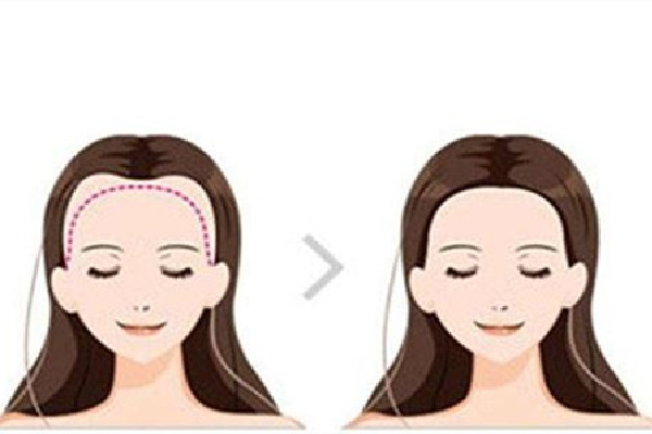 植發(fā)毛囊存活率高嗎 植發(fā)毛囊不夠怎么辦 植發(fā)毛囊存活率高嗎 植發(fā)毛囊不夠怎么辦