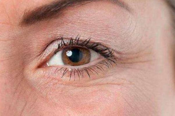 魚(yú)尾紋怎么才能去掉 魚(yú)尾紋是哪個(gè)部位 魚(yú)尾紋怎么才能去掉 魚(yú)尾紋是哪個(gè)部位