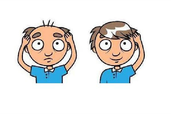 植發(fā)會不會再次脫落 植發(fā)用的是自己的頭發(fā)嗎 植發(fā)會不會再次脫落 植發(fā)用的是自己的頭發(fā)嗎