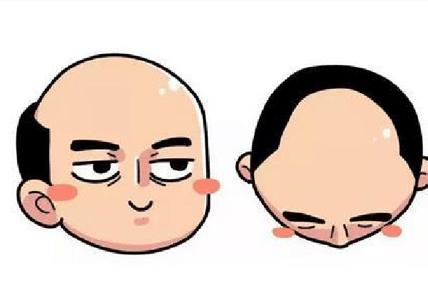 植發(fā)用的是哪里的毛囊 植發(fā)會(huì)不會(huì)有什么副作用 植發(fā)用的是哪里的毛囊 植發(fā)會(huì)不會(huì)有什么副作用