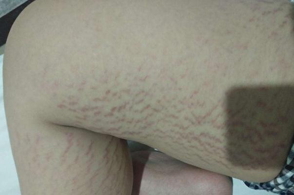 肥胖紋會自動消失嗎 肥胖紋的形成 肥胖紋會自動消失嗎 肥胖紋的形成