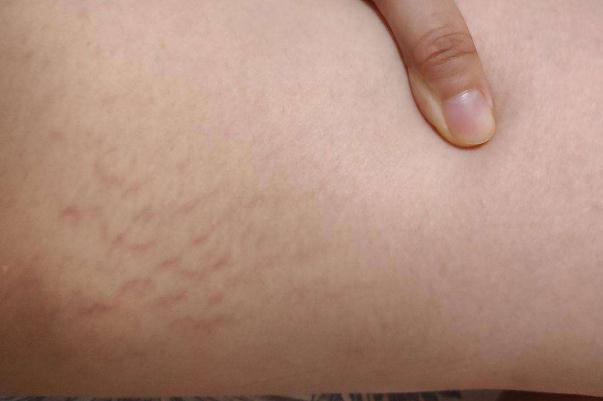 肥胖紋會自動消失嗎 肥胖紋的形成 肥胖紋會自動消失嗎 肥胖紋的形成