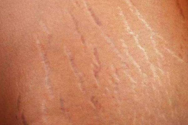 肥胖紋是橫的還是豎的 肥胖紋要多久才能完全消除嗎 肥胖紋是橫的還是豎的 肥胖紋要多久才能完全消除嗎