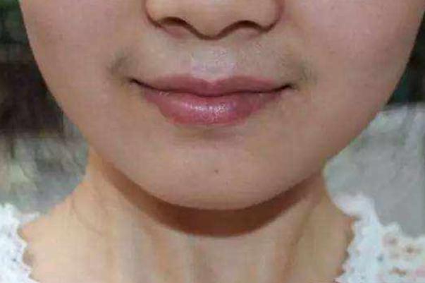 唇毛怎么去除永久 唇毛脫了會(huì)不會(huì)越長(zhǎng)越多 唇毛怎么去除永久 唇毛脫了會(huì)不會(huì)越長(zhǎng)越多