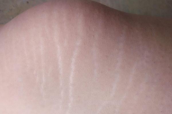 肥胖紋要注意什么 肥胖紋有什么影響嗎 肥胖紋要注意什么 肥胖紋有什么影響嗎