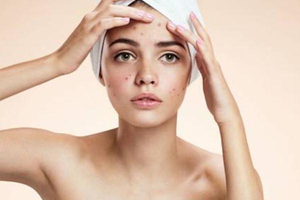 痘痘肌膚適合用什么面霜 痘痘肌的形成原因 痘痘肌膚適合用什么面霜 痘痘肌的形成原因