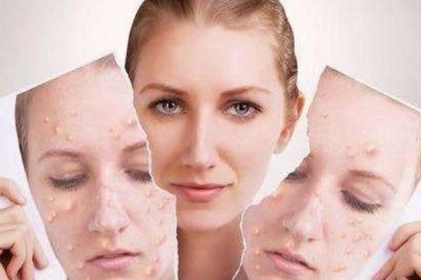 痘痘肌膚有哪幾種類型 痘痘肌膚有什么特征 痘痘肌膚有哪幾種類型 痘痘肌膚有什么特征