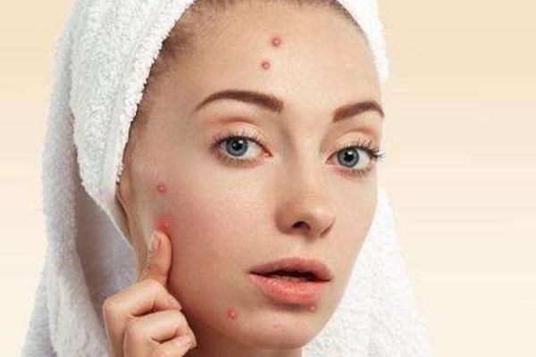 痘痘肌膚怎么修復 痘痘肌膚適合用什么牌子的護膚品 痘痘肌膚怎么修復 痘痘肌膚適合用什么牌子的護膚品