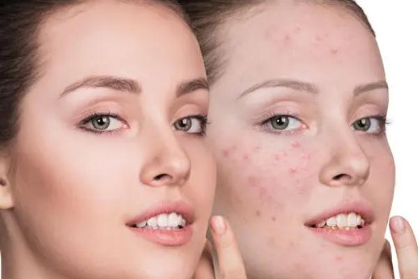 痘痘肌膚適合用什么面霜 痘痘肌的形成原因 痘痘肌膚適合用什么面霜 痘痘肌的形成原因