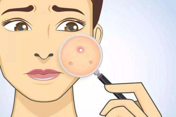 痘痘肌膚會不會遺傳 痘痘肌膚會自動修復嗎 痘痘肌膚會不會遺傳 痘痘肌膚會自動修復嗎