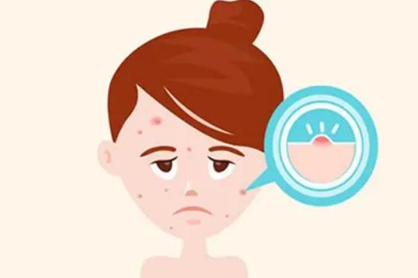 痘痘肌膚會不會遺傳 痘痘肌膚會自動修復嗎 痘痘肌膚會不會遺傳 痘痘肌膚會自動修復嗎