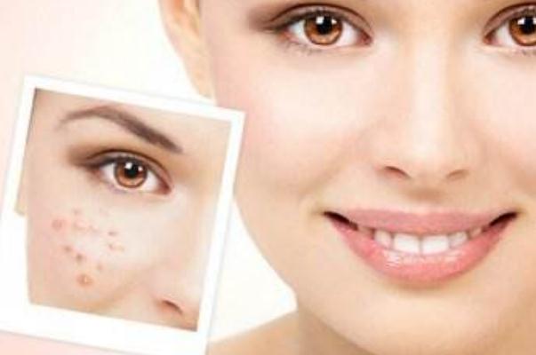 痘痘肌膚要涂防曬嗎 痘痘肌是先補水還是先祛痘 痘痘肌膚要涂防曬嗎 痘痘肌是先補水還是先祛痘