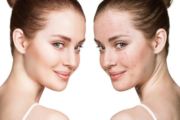 痘痘肌膚會不會遺傳 痘痘肌膚會自動修復嗎 痘痘肌膚會不會遺傳 痘痘肌膚會自動修復嗎