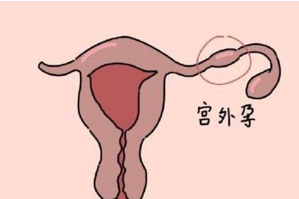 宮外孕試紙能測出來嗎 宮外孕hcg值的范圍 宮外孕試紙能測出來嗎 宮外孕hcg值的范圍