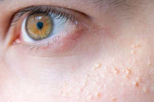 脂肪粒能用針挑掉嗎 脂肪粒挑了后怎么處理 脂肪粒能用針挑掉嗎 脂肪粒挑了后怎么處理