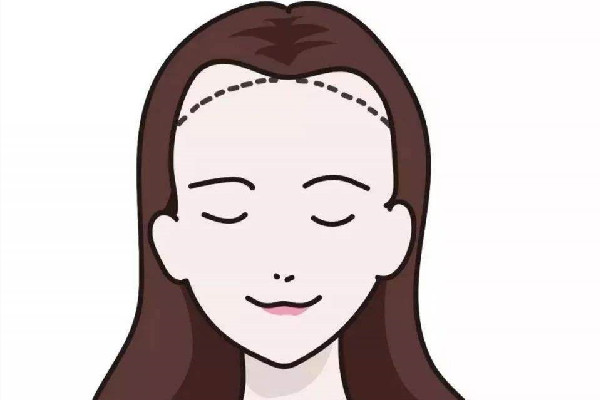 發(fā)際線會(huì)遺傳嗎 發(fā)際線會(huì)不會(huì)越來(lái)越高