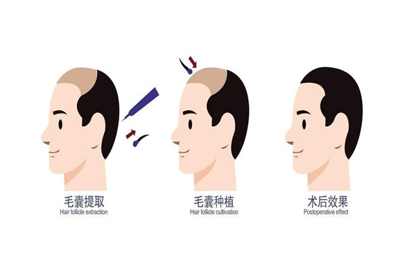 種植發(fā)際線(xiàn)有危險(xiǎn)嗎 種植發(fā)際線(xiàn)會(huì)掉嗎