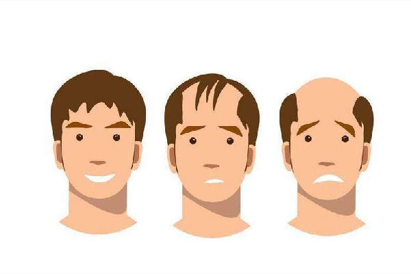 發(fā)際線會(huì)長(zhǎng)回來(lái)嗎 發(fā)際線和年齡有關(guān)系嗎 發(fā)際線會(huì)長(zhǎng)回來(lái)嗎 發(fā)際線和年齡有關(guān)系嗎