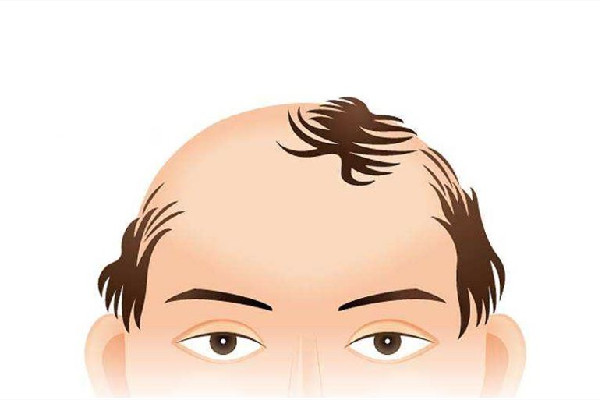 發(fā)際線會遺傳嗎 發(fā)際線會不會越來越高 發(fā)際線會遺傳嗎 發(fā)際線會不會越來越高