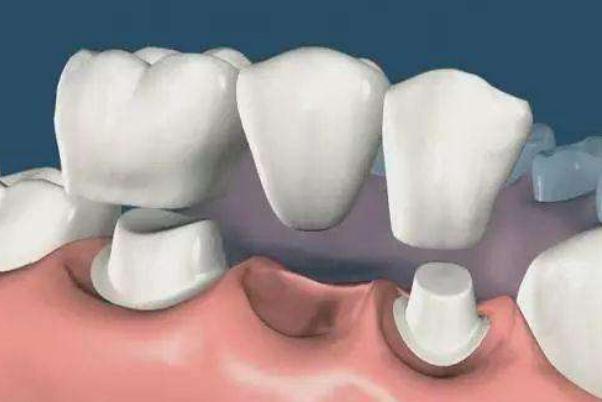 鑲牙多少錢一顆牙 鑲牙和種牙的區(qū)別 鑲牙多少錢一顆牙 鑲牙和種牙的區(qū)別