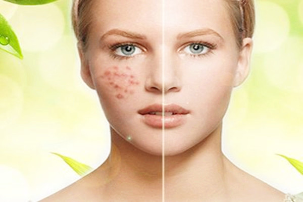 痘痘是怎么形成的 13歲女孩擠痘痘誘發(fā)敗血癥 痘痘是怎么形成的 13歲女孩擠痘痘誘發(fā)敗血癥