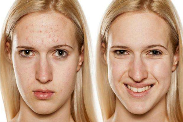 長痘痘能化妝嗎 長痘痘化妝怎么打底 長痘痘能化妝嗎 長痘痘化妝怎么打底