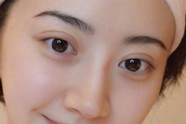 割雙眼皮需要多少錢一次 割雙眼皮大概多久能恢復正常 割雙眼皮需要多少錢一次 割雙眼皮大概多久能恢復正常