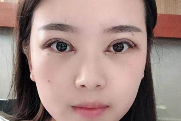 割雙眼皮需要多少錢一次 割雙眼皮大概多久能恢復正常 割雙眼皮需要多少錢一次 割雙眼皮大概多久能恢復正常