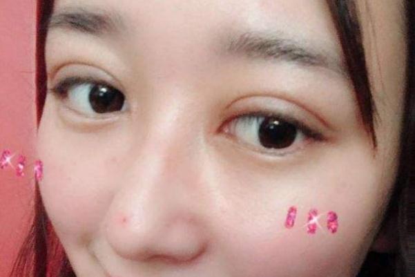 割雙眼皮會傷害眼睛嗎 割雙眼皮會割到眼部神經(jīng)嗎 割雙眼皮會傷害眼睛嗎 割雙眼皮會割到眼部神經(jīng)嗎
