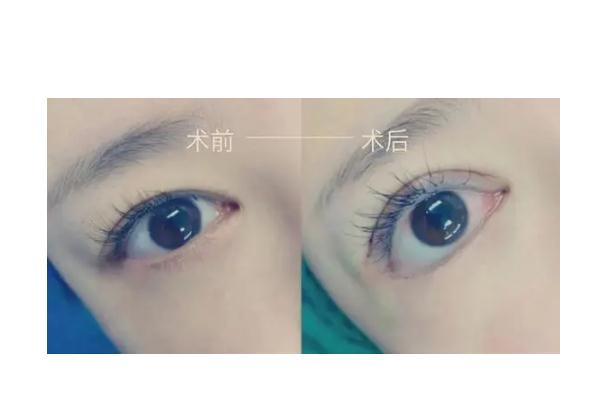 割雙眼皮是去醫(yī)院好還是整形醫(yī)院好 割雙眼皮是冬天好還是夏天好 割雙眼皮是去醫(yī)院好還是整形醫(yī)院好 割雙眼皮是冬天好還是夏天好