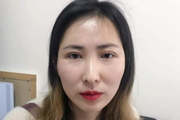 割雙眼皮對視力有影響嗎 割雙眼皮可以維持一輩子嗎 割雙眼皮對視力有影響嗎 割雙眼皮可以維持一輩子嗎