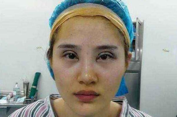 割雙眼皮需要多少錢一次 割雙眼皮大概多久能恢復正常 割雙眼皮需要多少錢一次 割雙眼皮大概多久能恢復正常