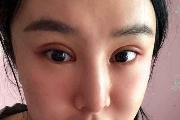 割雙眼皮是幾級疼痛 割雙眼皮要多長時間完成 割雙眼皮是幾級疼痛 割雙眼皮要多長時間完成