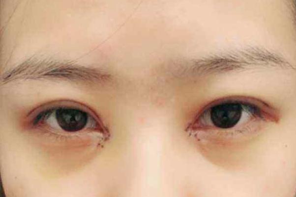 割雙眼皮可以吃炸雞嗎 割雙眼皮后護理 割雙眼皮可以吃炸雞嗎 割雙眼皮后護理