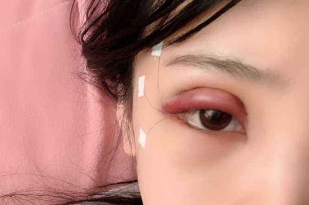 割雙眼皮對視力有影響嗎 割雙眼皮可以維持一輩子嗎 割雙眼皮對視力有影響嗎 割雙眼皮可以維持一輩子嗎