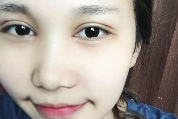 割雙眼皮對視力有影響嗎 割雙眼皮可以維持一輩子嗎 割雙眼皮對視力有影響嗎 割雙眼皮可以維持一輩子嗎