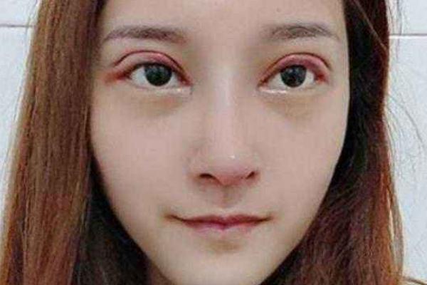 割雙眼皮有哪些風險 割雙眼皮有哪些副作用 割雙眼皮有哪些風險 割雙眼皮有哪些副作用