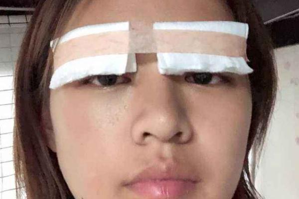 割雙眼皮是幾級疼痛 割雙眼皮要多長時間完成 割雙眼皮是幾級疼痛 割雙眼皮要多長時間完成