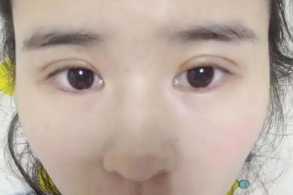 割雙眼皮可以吃炸雞嗎 割雙眼皮后護理 割雙眼皮可以吃炸雞嗎 割雙眼皮后護理