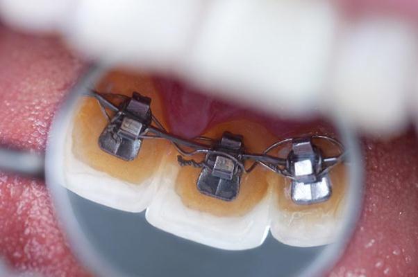 牙套會(huì)使牙齒松動(dòng)嗎 牙套會(huì)不會(huì)掉下來 牙套會(huì)使牙齒松動(dòng)嗎 牙套會(huì)不會(huì)掉下來