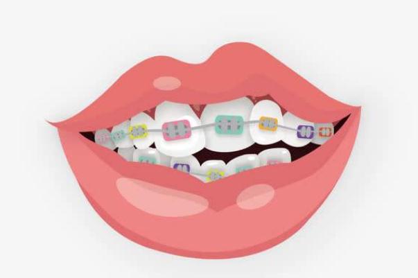 牙套要戴一輩子嗎 牙套要全天戴嗎 牙套要戴一輩子嗎 牙套要全天戴嗎