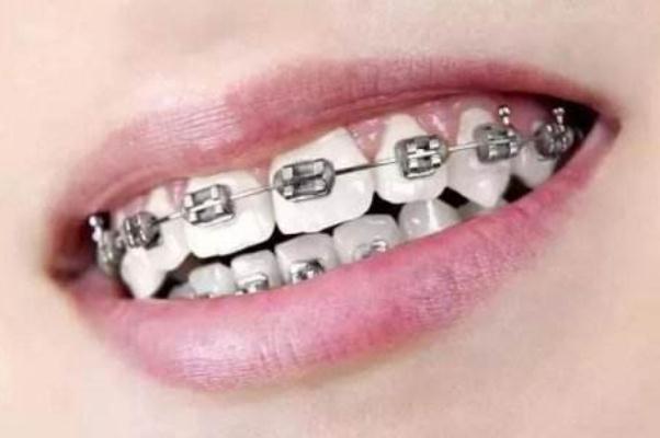 牙套的種類和價格 牙套價格一般是多少錢一個 牙套的種類和價格 牙套價格一般是多少錢一個