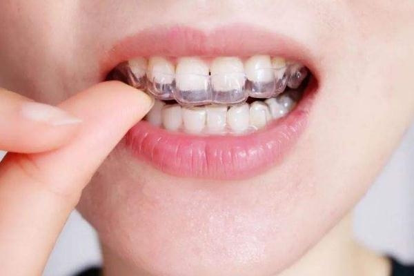 隱形牙套費用大概多少 隱形牙套和鋼絲牙套哪個效果更好 隱形牙套費用大概多少 隱形牙套和鋼絲牙套哪個效果更好