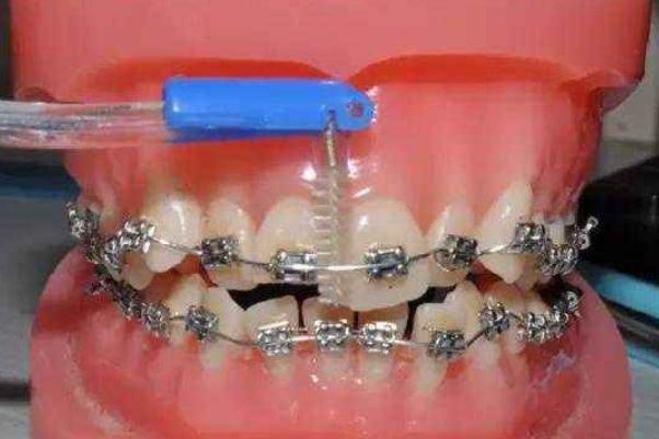牙套要戴一輩子嗎 牙套要全天戴嗎 牙套要戴一輩子嗎 牙套要全天戴嗎