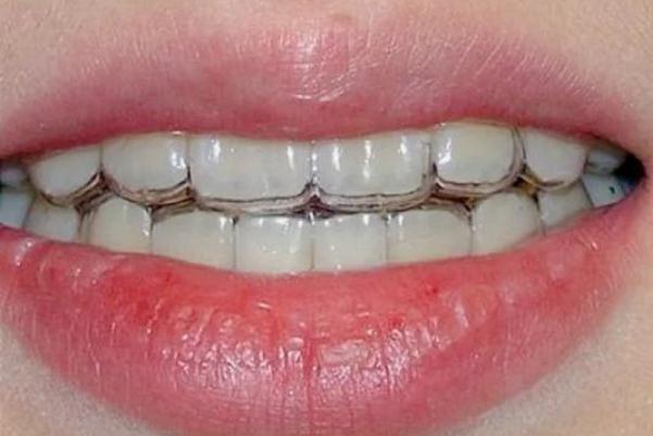 隱形牙套費用大概多少 隱形牙套和鋼絲牙套哪個效果更好 隱形牙套費用大概多少 隱形牙套和鋼絲牙套哪個效果更好