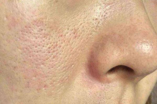 收縮毛孔最佳方法 收縮毛孔用什么比較好 收縮毛孔最佳方法 收縮毛孔用什么比較好