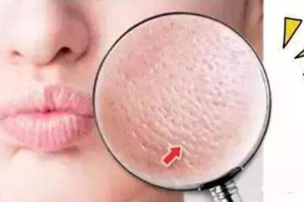 收縮毛孔會不會長痘 造成毛孔粗大的因素 收縮毛孔會不會長痘 造成毛孔粗大的因素